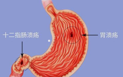 十二指肠溃疡有哪些症状 老中医张林茂告诉你溃疡病如何用药及自我调理 百姓健康网 比较好的医疗保健养生网 91健康网